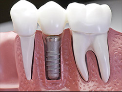 dental implants
