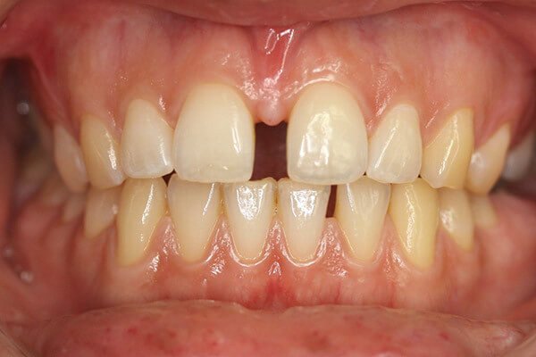 veneers gap mm hated patient