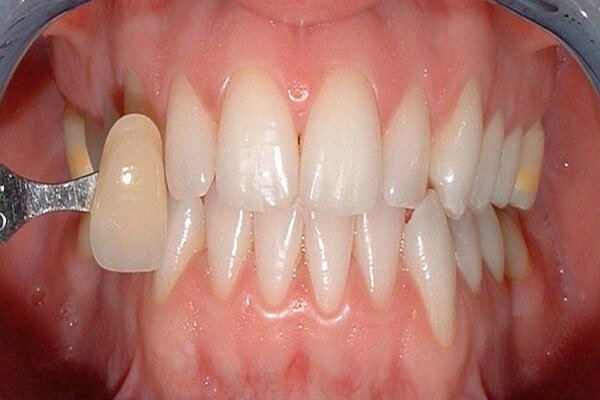 Teeth Whitening Kent | Cosmetic Dentist | Birkbeck Dentistry