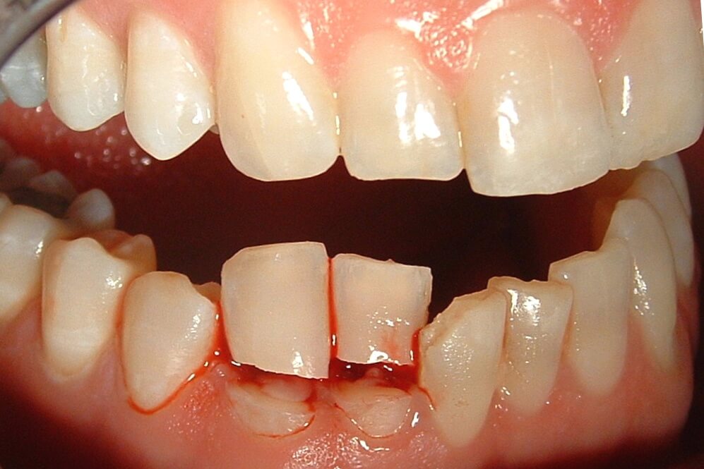 Before