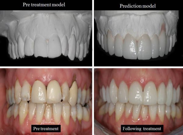 Stages of treatment