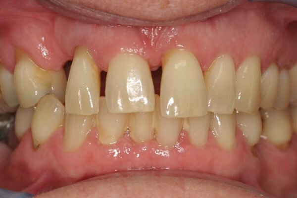 Close up view of spacing and gaps
