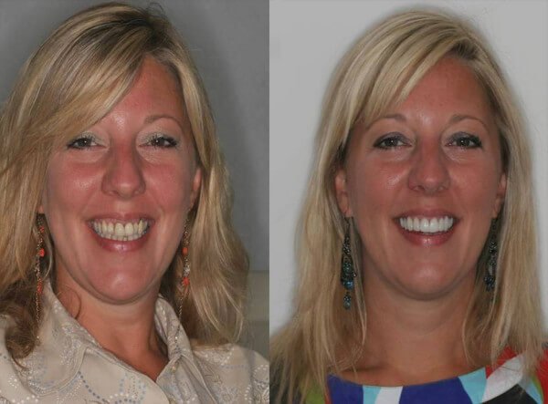 Before and After result