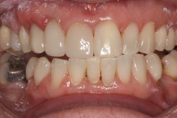 Spaces closed using an implant and additional veneers