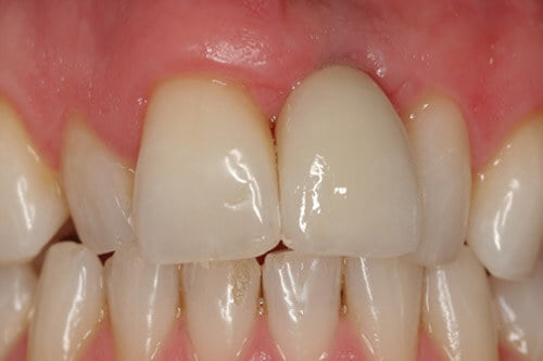 A ceramic crown restores aesthetics and speech