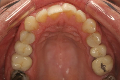 Following root treatment, amalgam replacement and ceramic crowns,