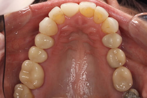 Following 2 implants, new crowns, ceramics  and replacement of old  filling