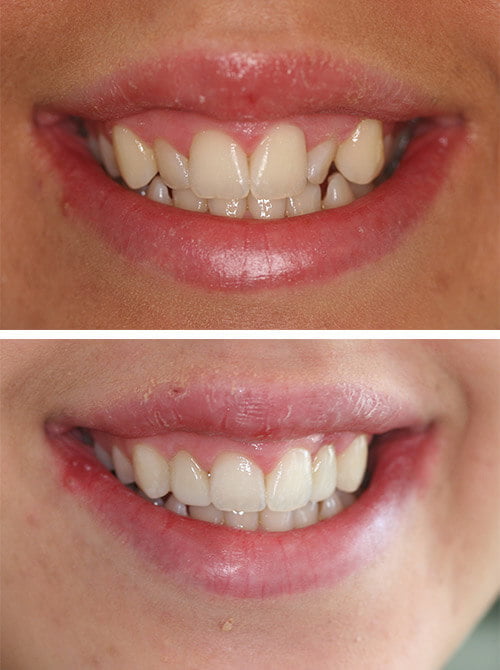 before-after