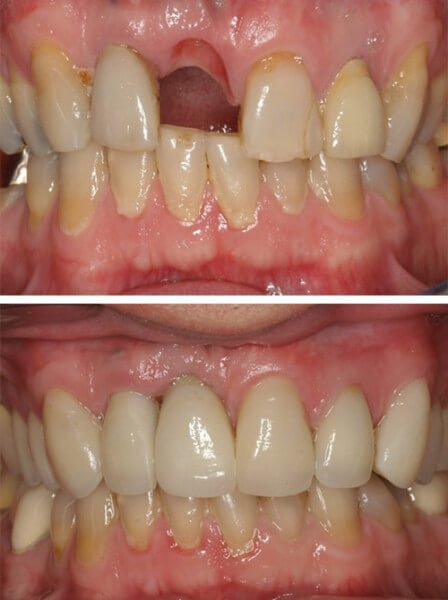 before-after