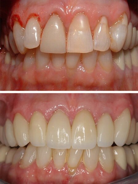 before-after