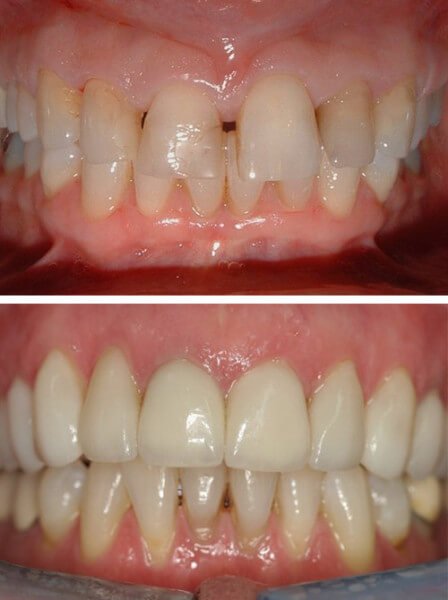 before-after