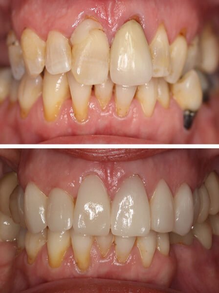 before-after