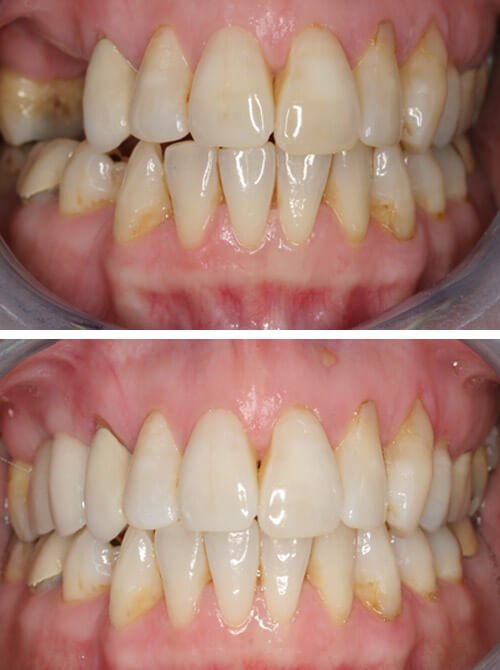 before-after
