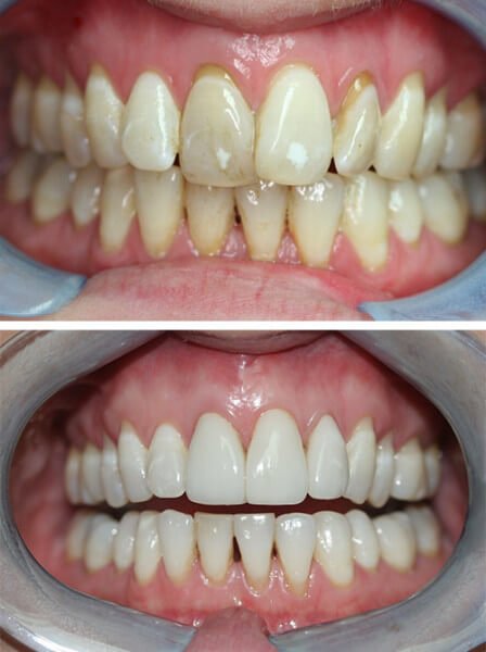 before-after