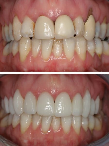 before-after