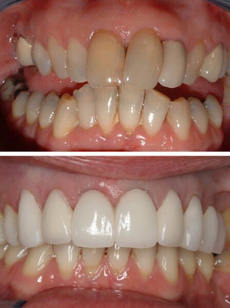 before-after