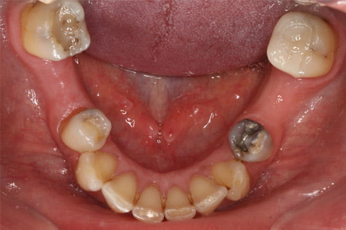 Gaps on both sides.