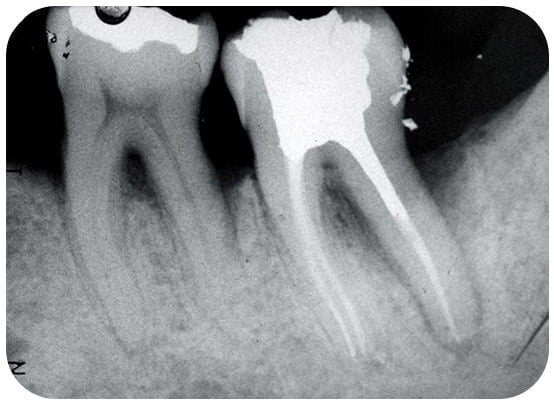 The canals cleaned and sealed- the tooth is now ready for a crown