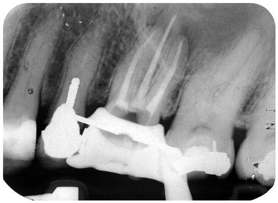 All 3 canals cleaned and sealed following a repeat root treatment.No tenderness
