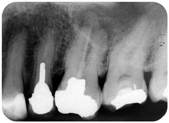 A tooth with a deep filling and a root filling that had only sealed 1 of the canals