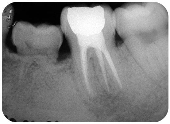 The infection disappeared as did the pain.