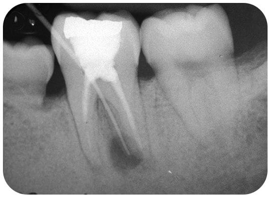 A grey circular area shows the infection below the root. An extra root was discovered and treated.
