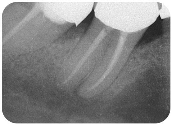 The infection has cleared following the root treatment.