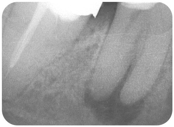 Grey area below a crowned tooth showing infection (abscess)