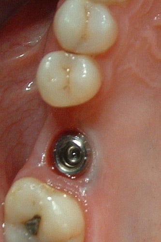 Dental Implant is placed at gum level