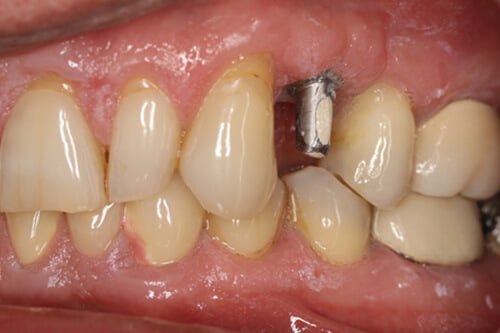 An attachment (abutment) is fitted to the implant