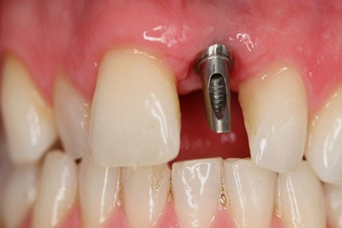 An abutment is fitted to the implant