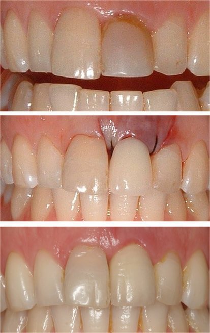Loose broken tooth, temporarily and then permanently replaced.