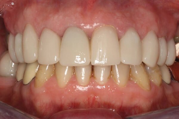 10 old crowns replaced in single 4hr visit!