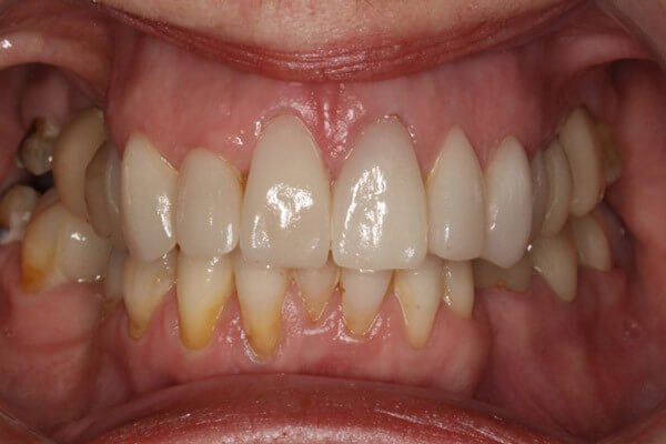 Replaced and restored with ceramics and implants.