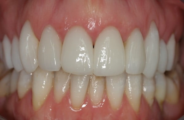 Cosmetic Smile Makeover