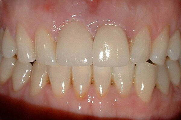 Following tooth whitening the crown was replaced with a ceramic crown