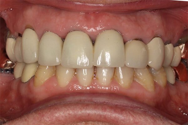 Old ceramic crowns with dark poor fitting edges