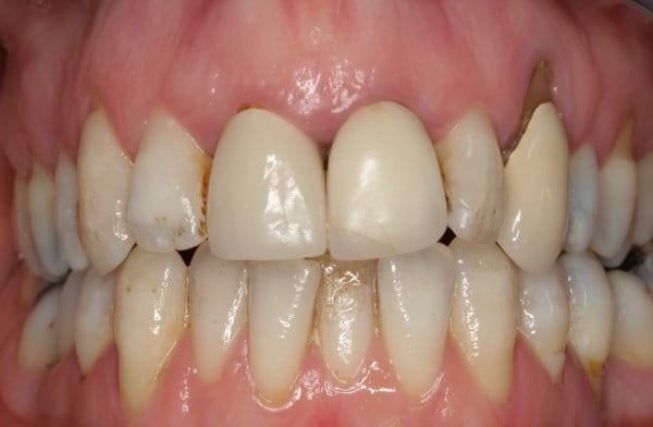 Dark discoloured mis-shaped teeth