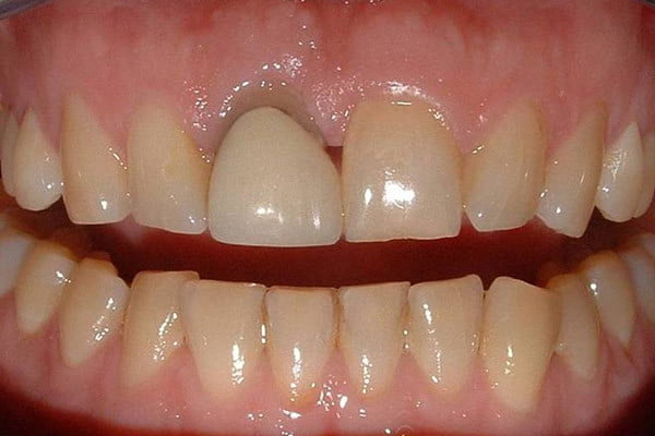 Yellow teeth and incorrectly shaped crown