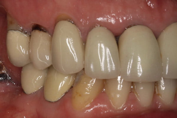 Dark edges showing metal and poor fitting crowns