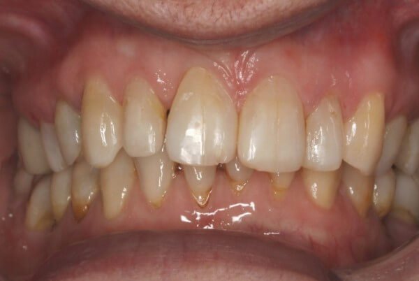 Gap closed and Brace removed (Only 6 months)
