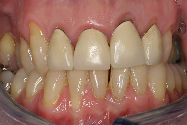 4 old porcelain crowns with metal showing at the edges