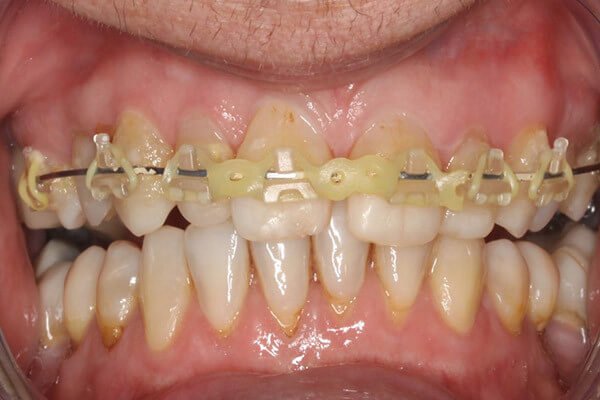 Brace fitted with tooth coloured brackets