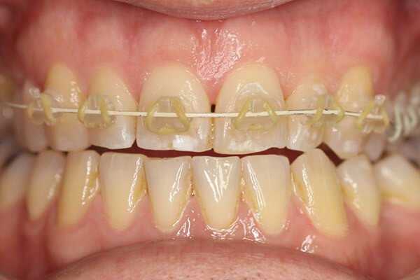 Clear fixed upper brace fitted