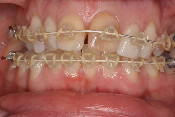 Fastbraces fitted