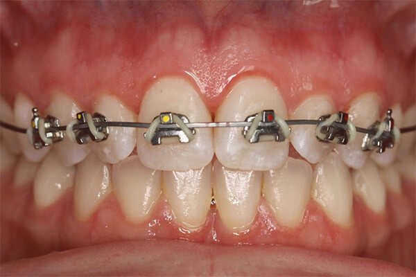 A fast brace is placed for 3 months