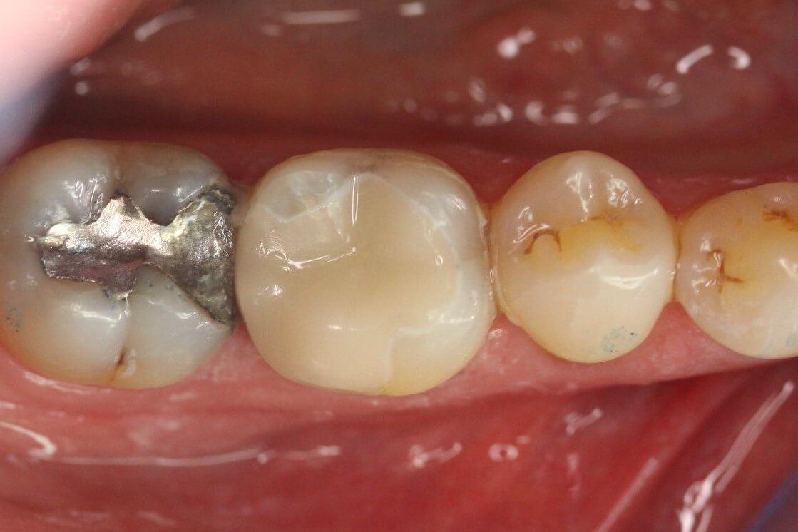 The tooth is restored within one hour with a ceramic restoration