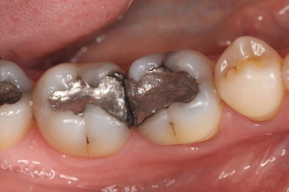 An old amalgam filling is removed