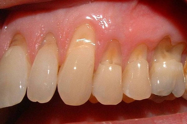 Defects and ridges at gum level.
