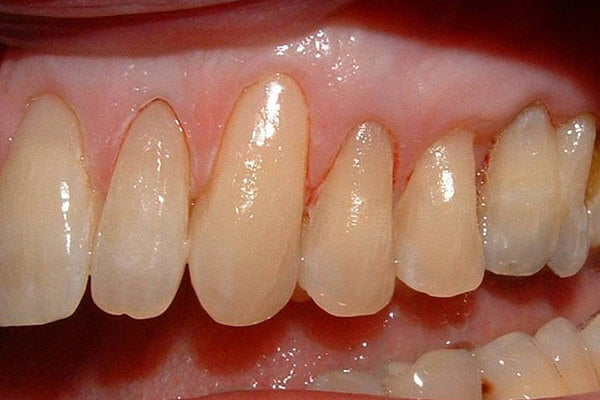 Protected with bonded resin in fills.